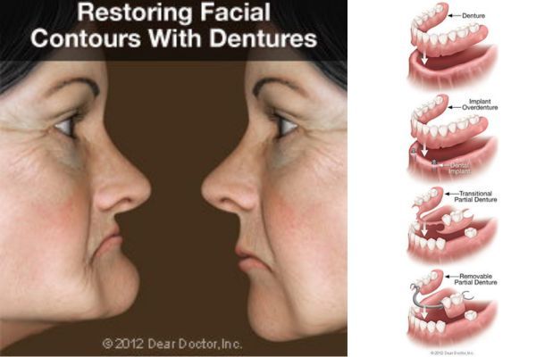 Removable dentures