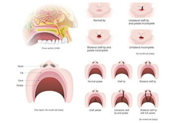 Cleft Lip and Palate
